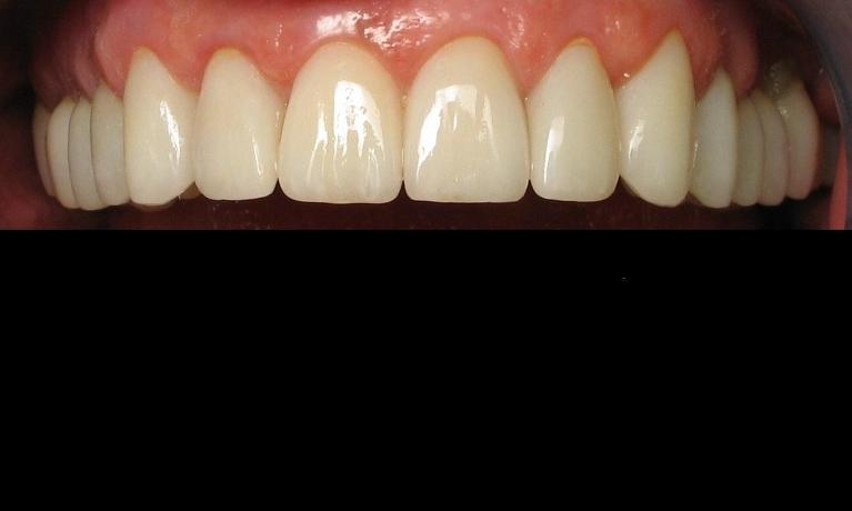 Ceramic-Crowns-After-Image